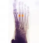 Are you experiencing top of foot pain after running? Depending on the severity of the pain, it could be a stress fracture, tendonitis or bone spurs. 