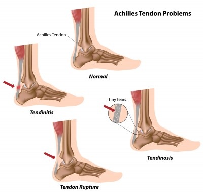 lump on my heel tendon