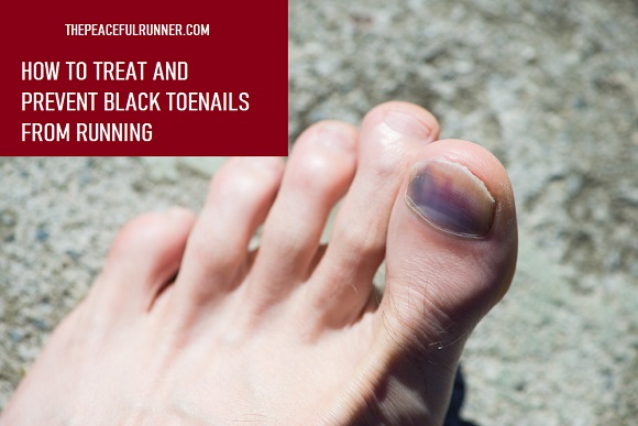 How to Prevent Black Toenails