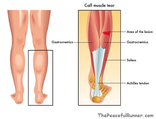 Calf Pain