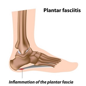 Plantar Fasciitis Injury Plantar Fasciitis Injury